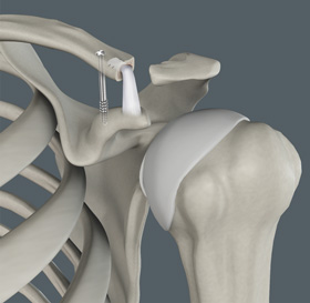 Arthritis of the Shoulder